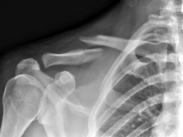 Right clavicle fracture